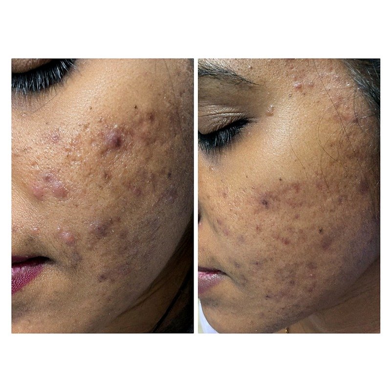 Before & After treatment result 9
